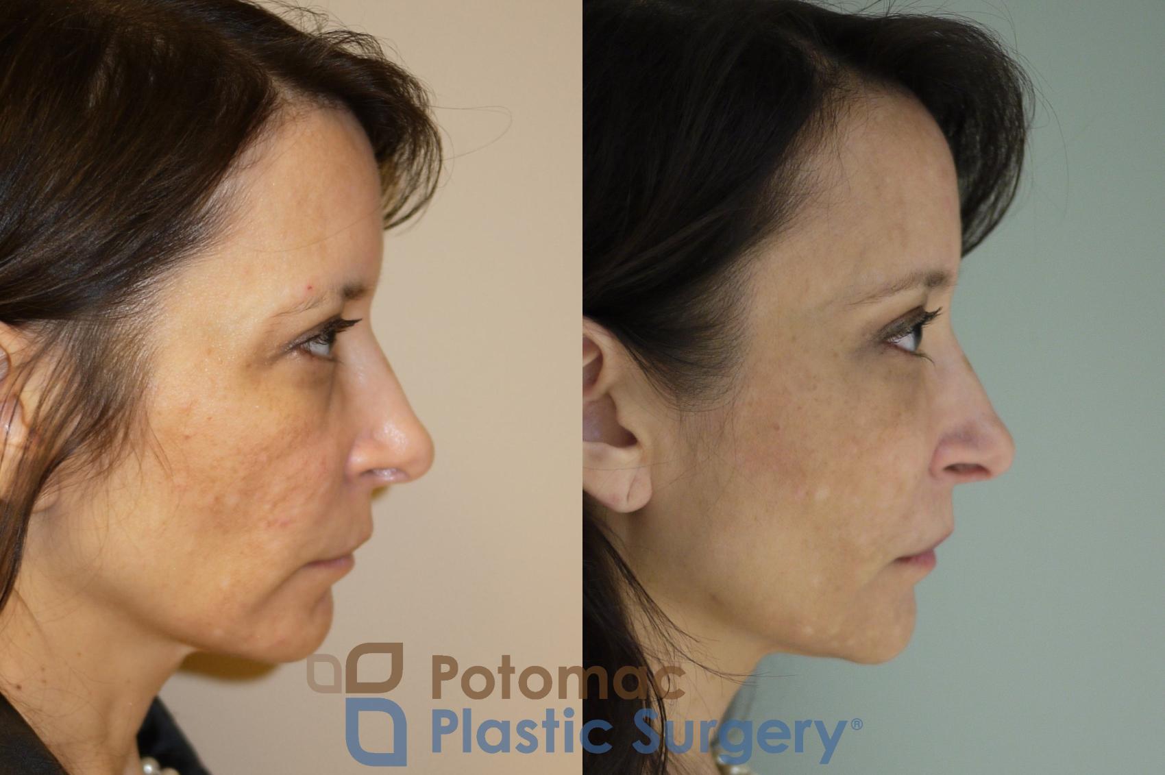 Before & After Brow Lift Case 57 Right Side View in Washington DC & Arlington , DC