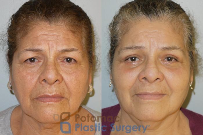 Before & After Blepharoplasty Case 69 Front View in Washington DC & Arlington , DC