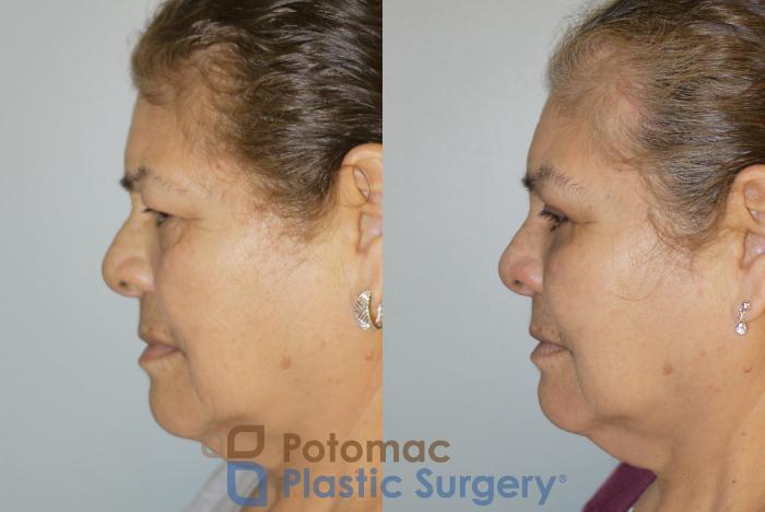 Before & After Brow Lift Case 69 Left Side View in Washington DC & Arlington , DC