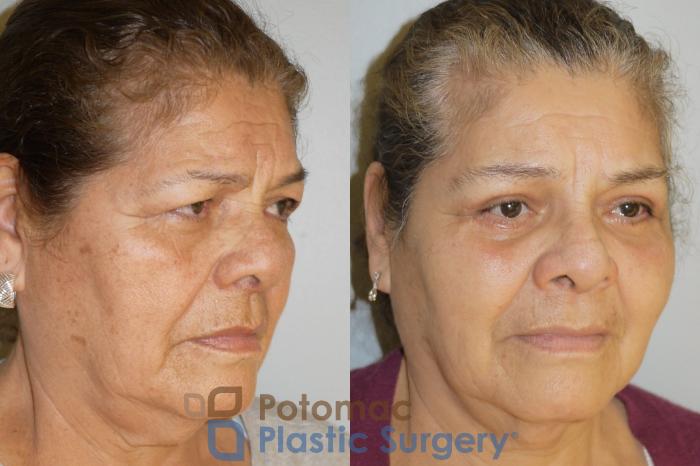 Before & After Brow Lift Case 69 Right Oblique View in Washington DC & Arlington , DC