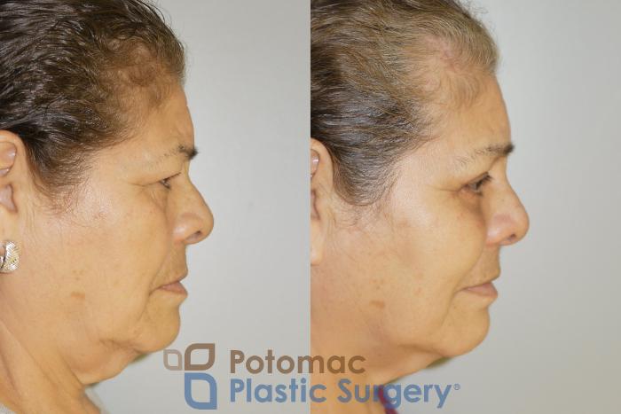 Before & After Blepharoplasty Case 69 Right Side View in Washington DC & Arlington , DC