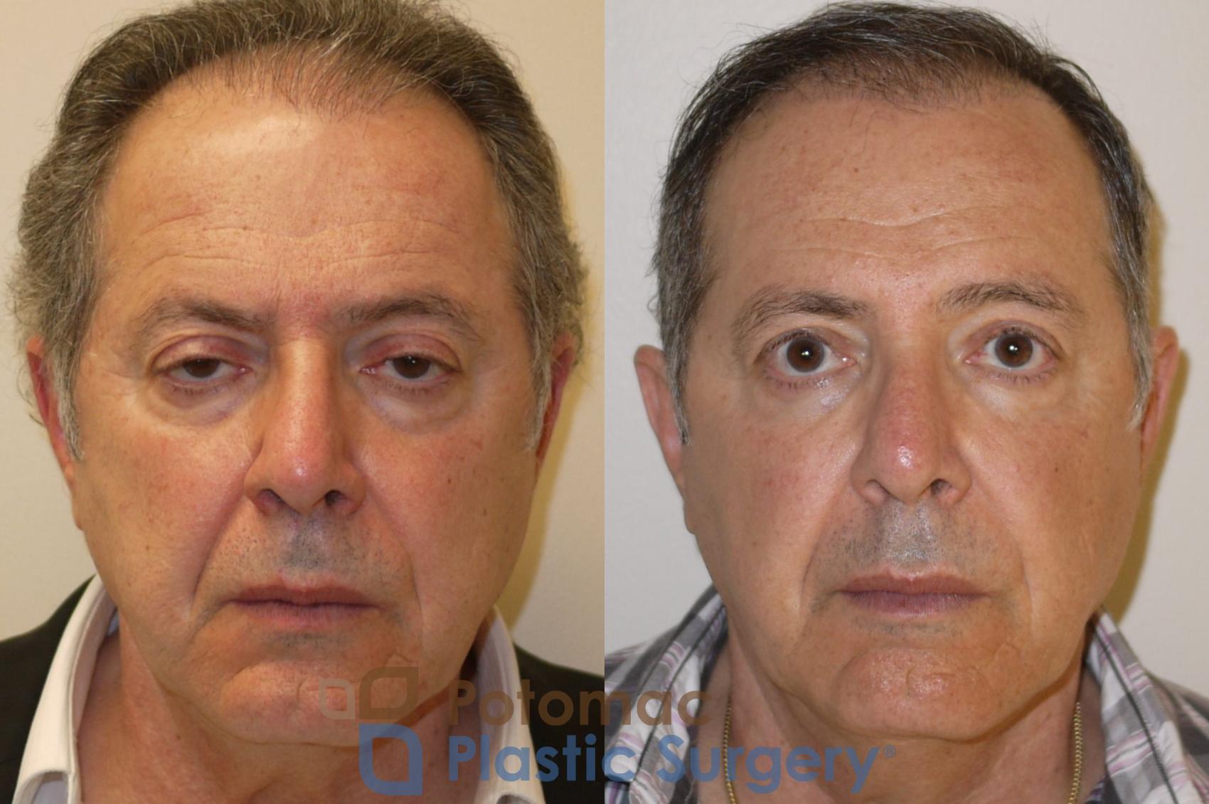 Before & After Blepharoplasty Case 78 Front View in Washington, DC