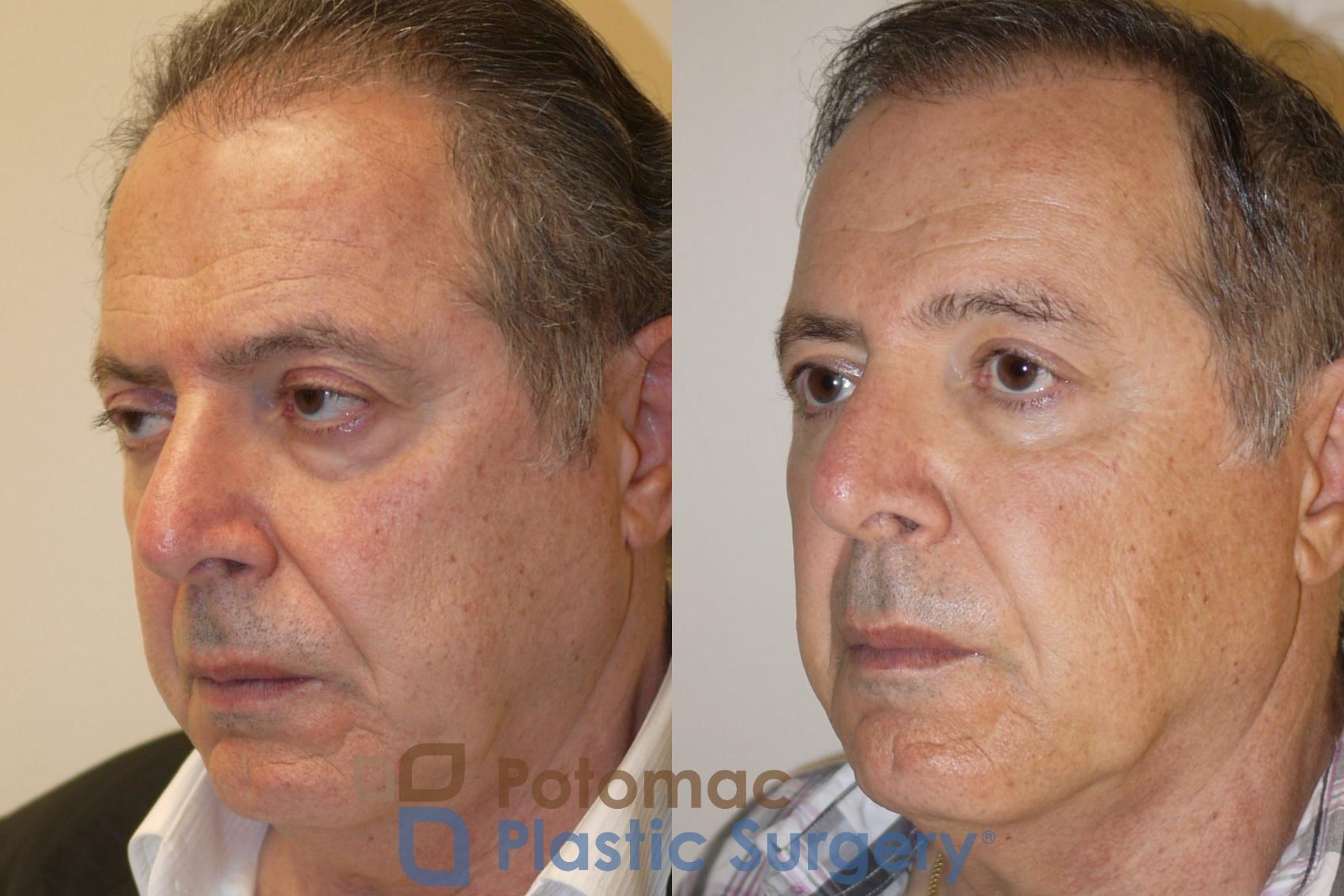 Before & After Brow Lift Case 78 Left Oblique View in Washington, DC