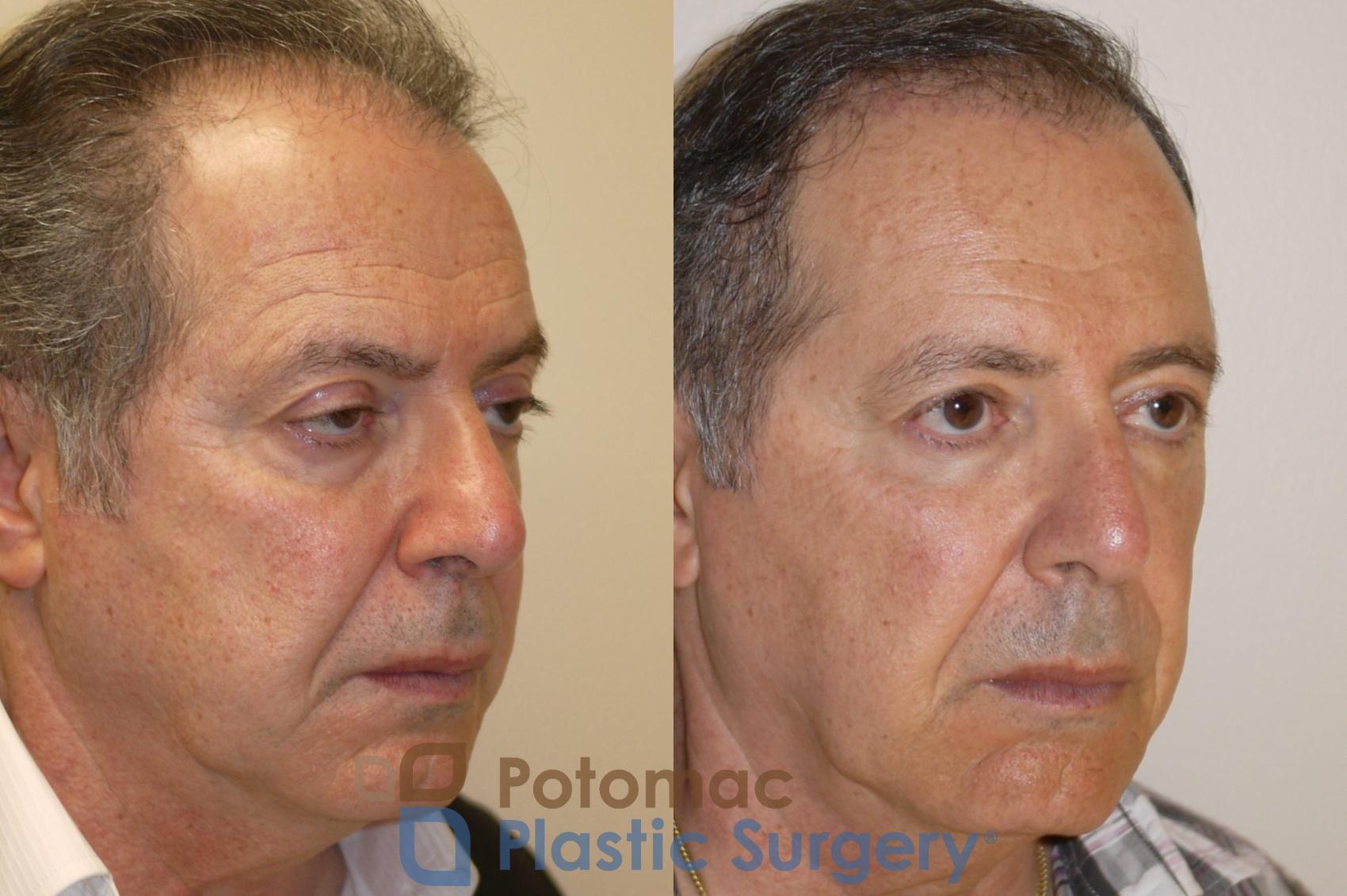 Before & After Brow Lift Case 78 Right Oblique View in Washington, DC