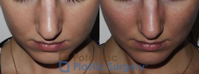 Before & After Buccal Fat Reduction Case 180 Above View in Washington DC & Arlington , DC