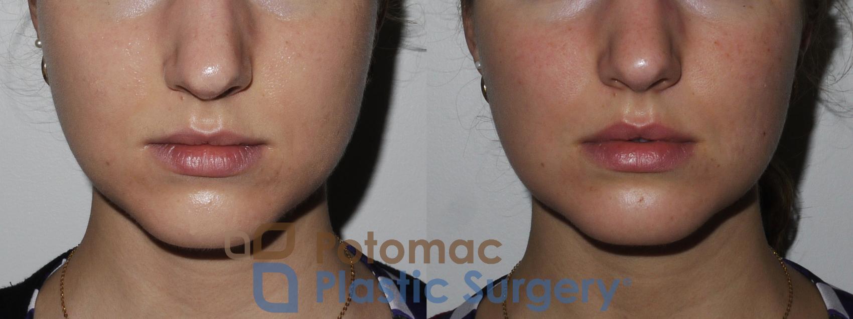 Before & After Buccal Fat Reduction Case 180 Front View #1 View in Washington, DC