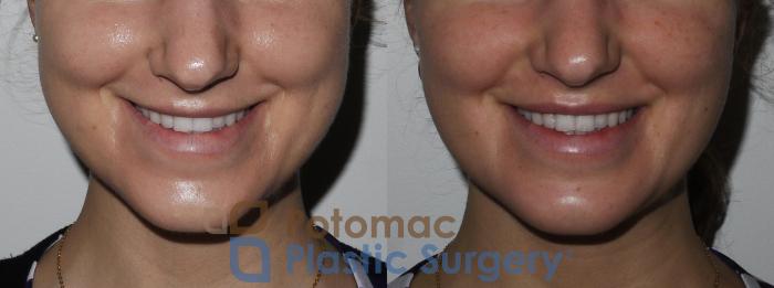Before & After Buccal Fat Reduction Case 180 Front View #2 View in Washington DC & Arlington , DC