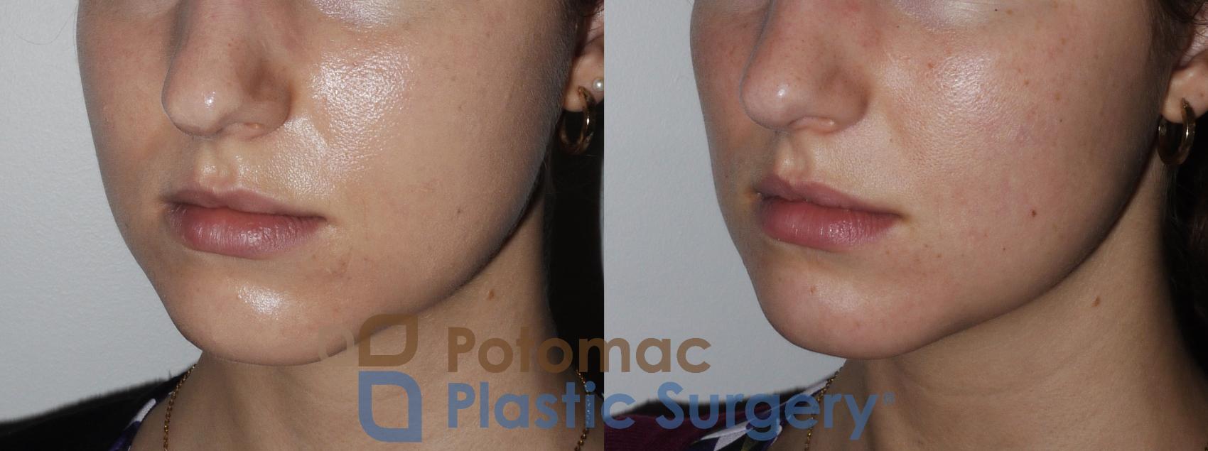Before & After Buccal Fat Reduction Case 180 Left Oblique View in Washington DC & Arlington , DC