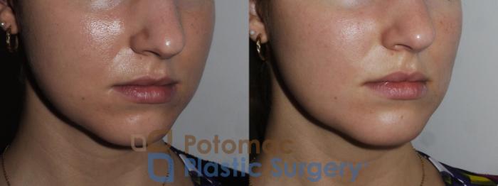 Before & After Buccal Fat Reduction Case 180 Right Oblique View in Washington DC & Arlington , DC