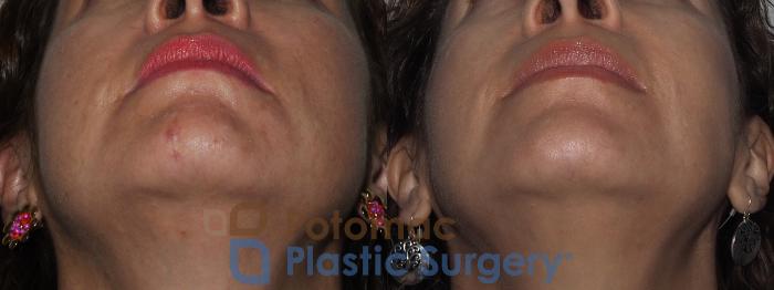Before & After Buccal Fat Reduction Case 221 Bottom View in Washington DC & Arlington , DC