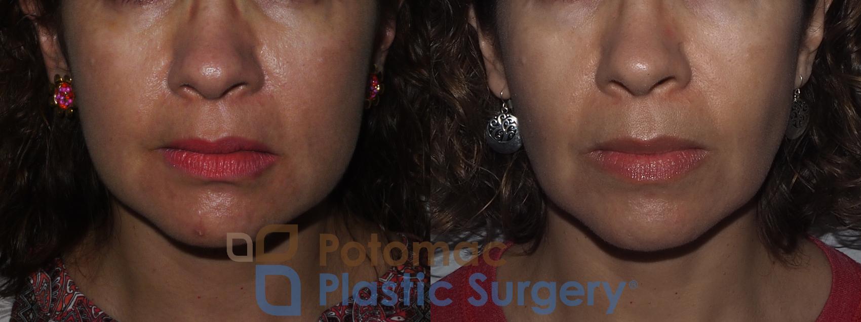Before & After Buccal Fat Reduction Case 221 Front View in Washington, DC