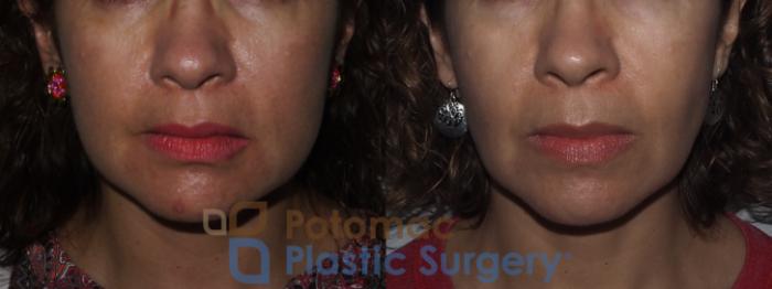 Before & After Facial Sculpting Case 221 Front View in Washington DC & Arlington , DC