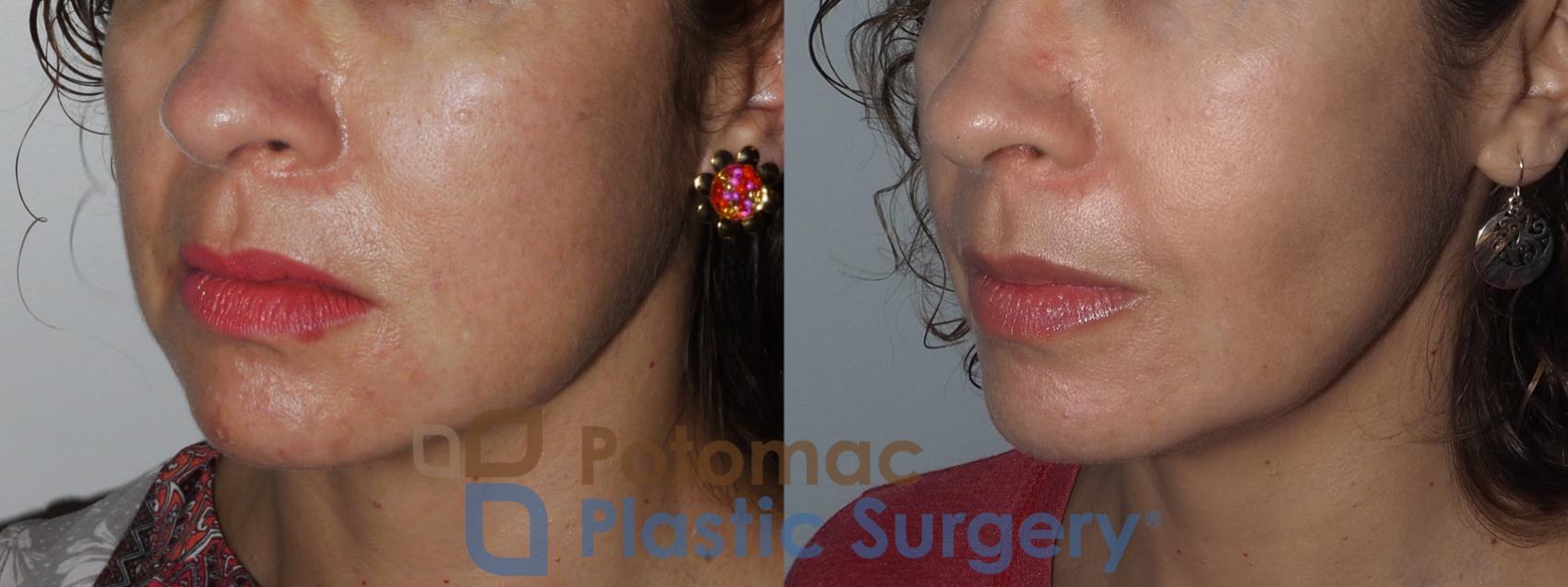 Before & After Buccal Fat Reduction Case 221 Left Oblique View in Washington DC & Arlington , DC