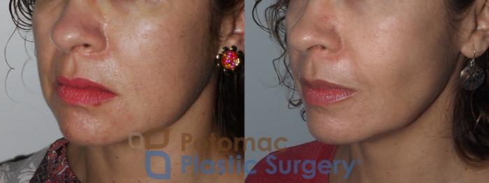 Before & After Facial Sculpting Case 221 Left Oblique View in Washington DC & Arlington , DC