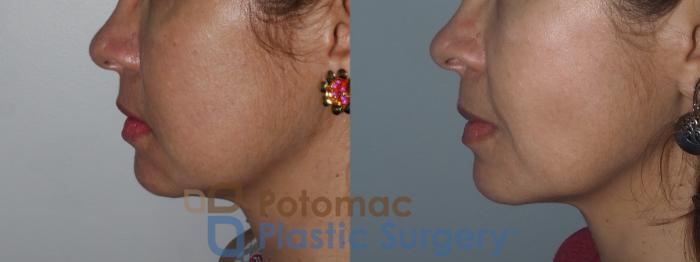 Before & After Facial Sculpting Case 221 Left Side View in Washington DC & Arlington , DC