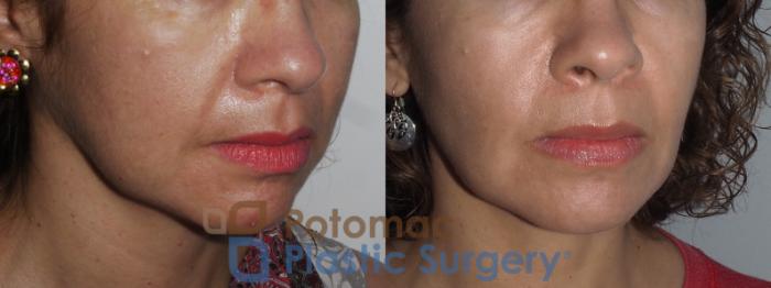 Before & After Buccal Fat Reduction Case 221 Right Oblique View in Washington DC & Arlington , DC