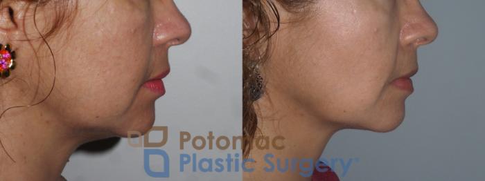 Before & After Facial Sculpting Case 221 Right Side View in Washington DC & Arlington , DC