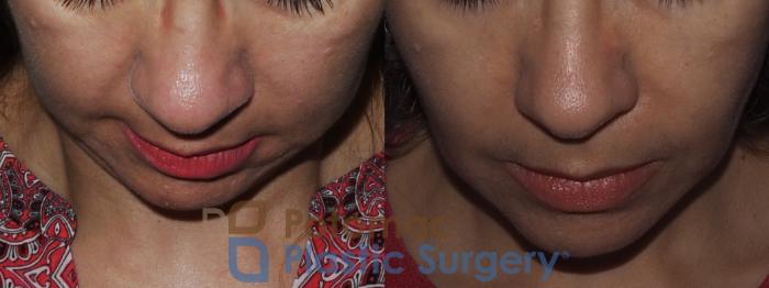 Before & After Buccal Fat Reduction Case 221 Top View in Washington DC & Arlington , DC