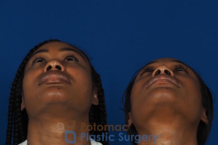 Before & After Buccal Fat Reduction Case 266 Bottom View in Washington DC & Arlington , DC