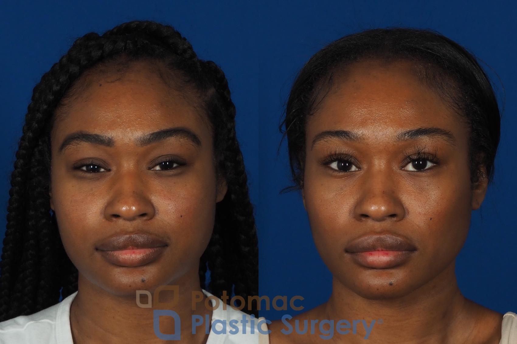 Before & After Facial Sculpting Case 266 Front View in Washington, DC