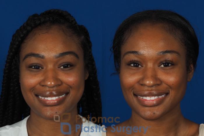 Before & After Buccal Fat Reduction Case 266 Front - Smiling View in Washington DC & Arlington , DC