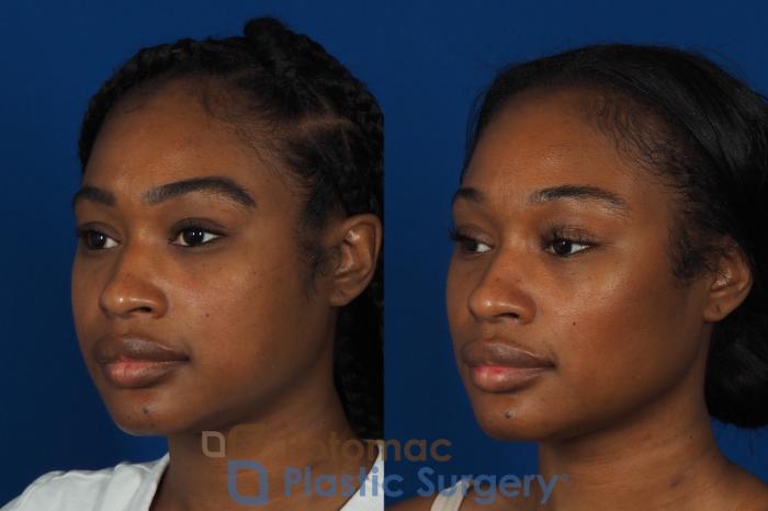 Before & After Buccal Fat Reduction Case 266 Left Oblique View in Washington DC & Arlington , DC