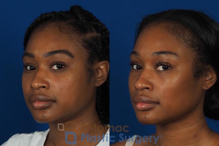 Before & After Buccal Fat Reduction Case 266 Left Oblique View #2 View in Washington DC & Arlington , DC
