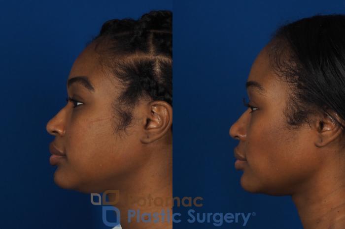 Before & After Buccal Fat Reduction Case 266 Left Side View in Washington DC & Arlington , DC