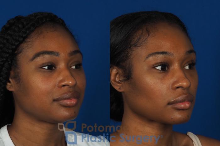 Before & After Buccal Fat Reduction Case 266 Right Oblique View in Washington DC & Arlington , DC