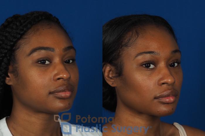 Before & After Buccal Fat Reduction Case 266 Right Oblique View #2 View in Washington DC & Arlington , DC
