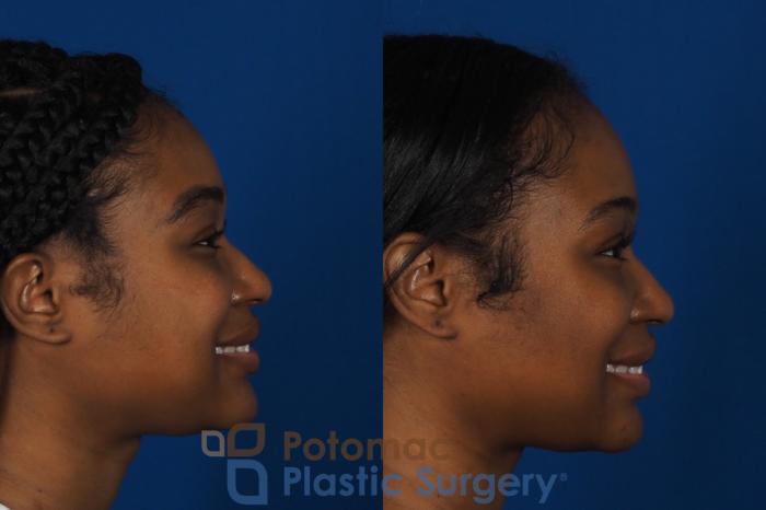 Before & After Facial Sculpting Case 266 Right Side - Smiling View in Washington DC & Arlington , DC