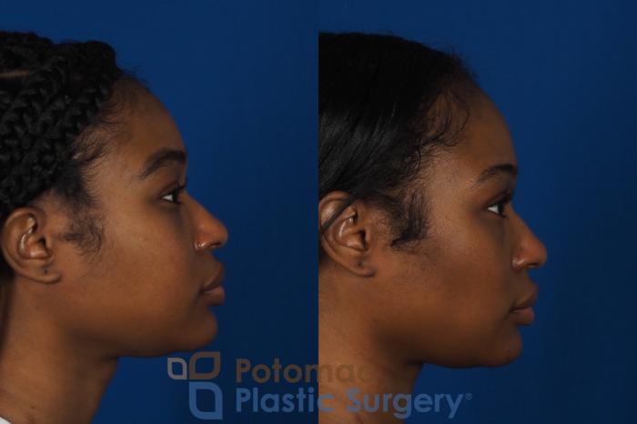 Before & After Buccal Fat Reduction Case 266 Right Side View in Washington DC & Arlington , DC