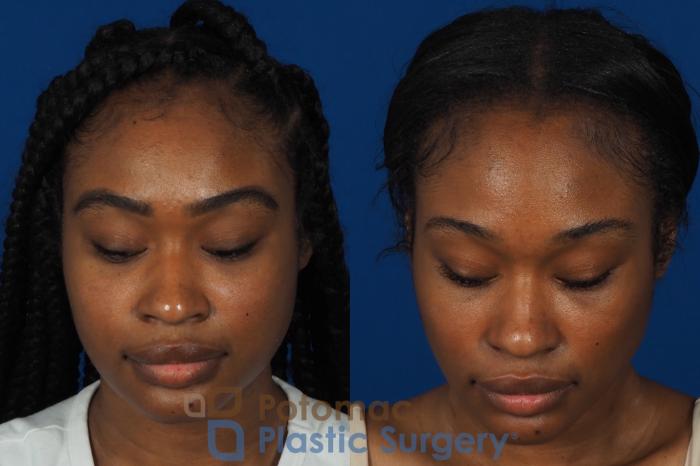 Before & After Buccal Fat Reduction Case 266 Top View in Washington DC & Arlington , DC