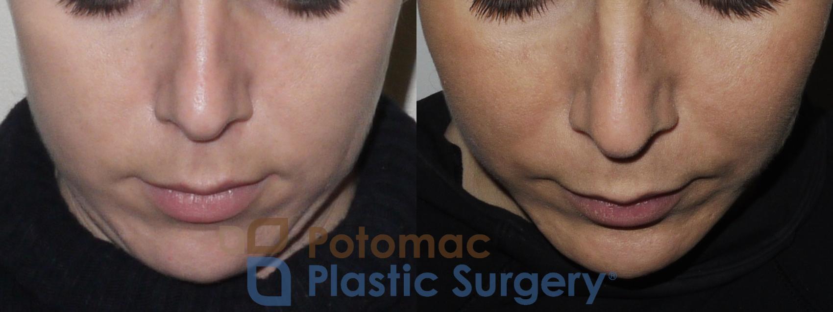 Before & After Chin Augmentation Case 162 Above View in Washington, DC