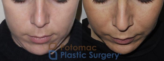 Before & After Cheek Augmentation Case 162 Above View in Washington, DC