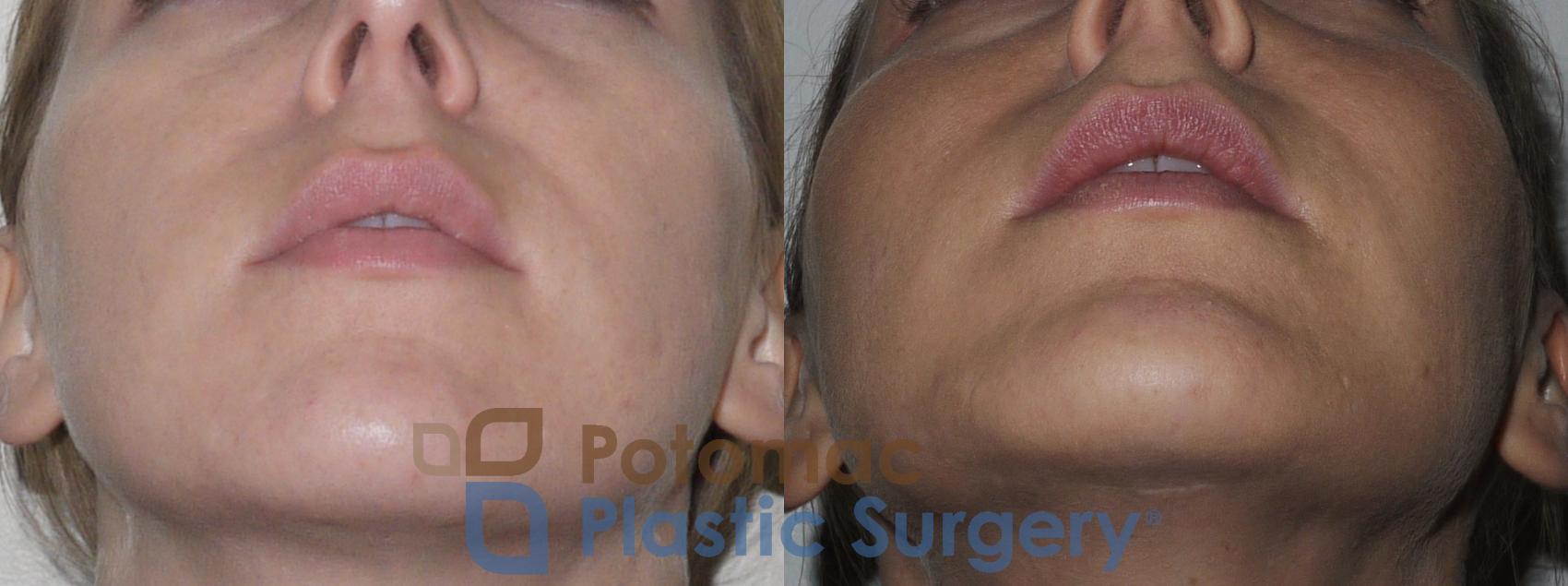 Before & After Chin Augmentation Case 162 Below View in Washington, DC