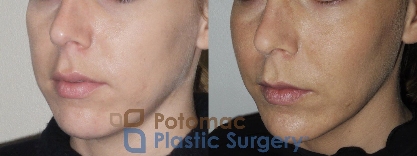 Before & After Chin Augmentation Case 162 Left Oblique View in Washington, DC