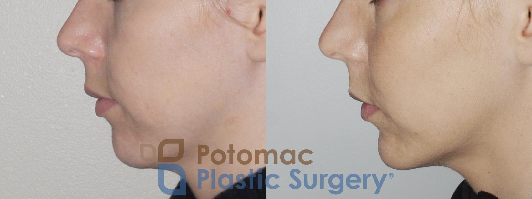 Before & After Cheek Augmentation Case 162 Left Side View in Washington, DC