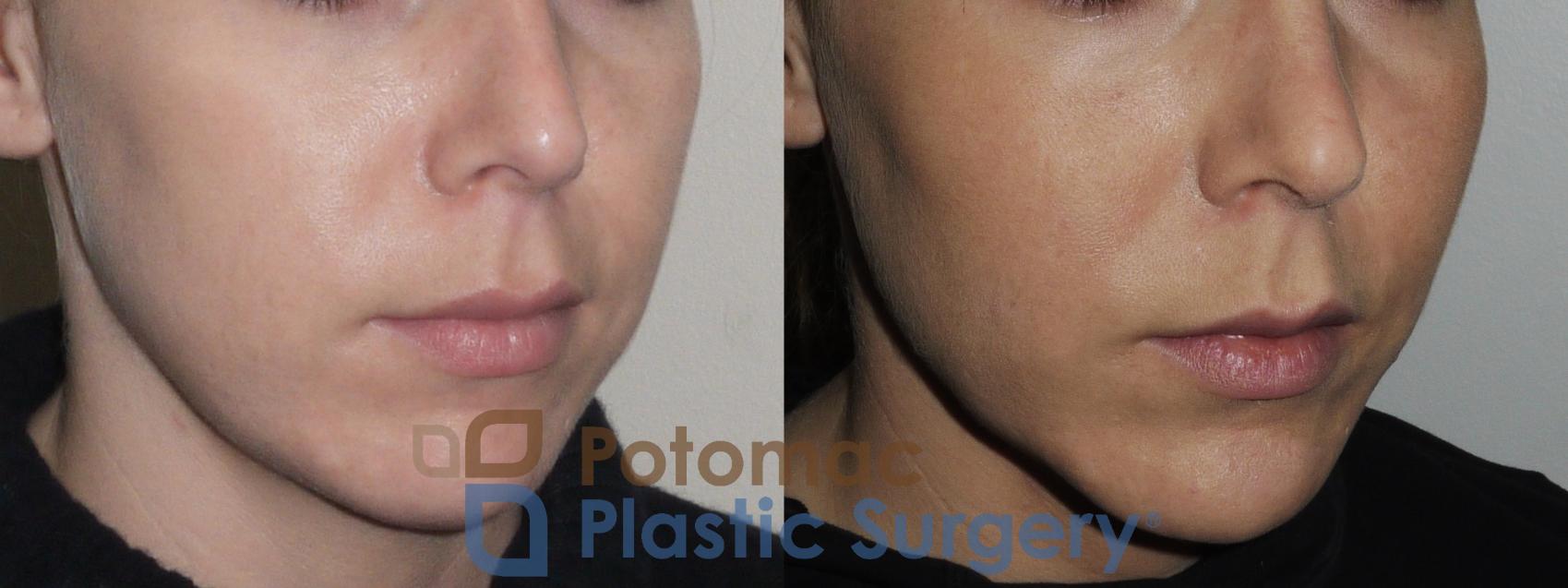 Before & After Cheek Augmentation Case 162 Right Oblique View in Washington, DC