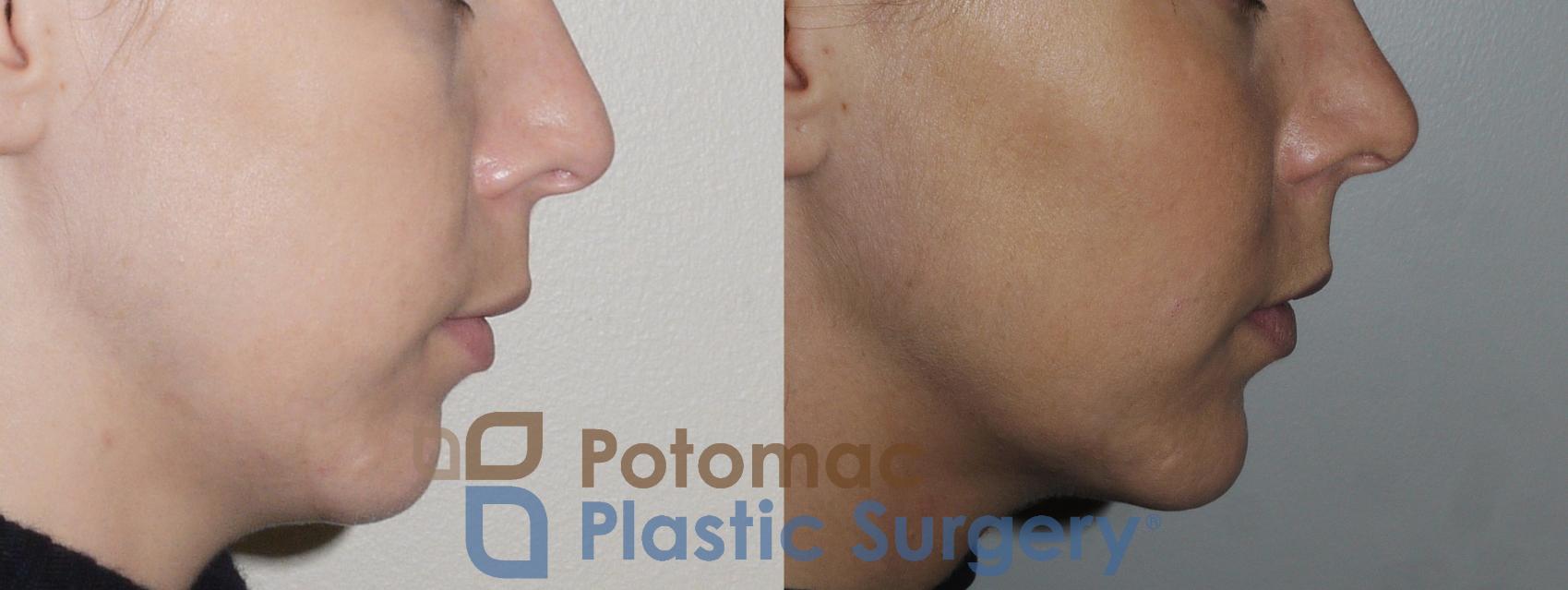 Before & After Chin Augmentation Case 162 Right Side View in Washington, DC
