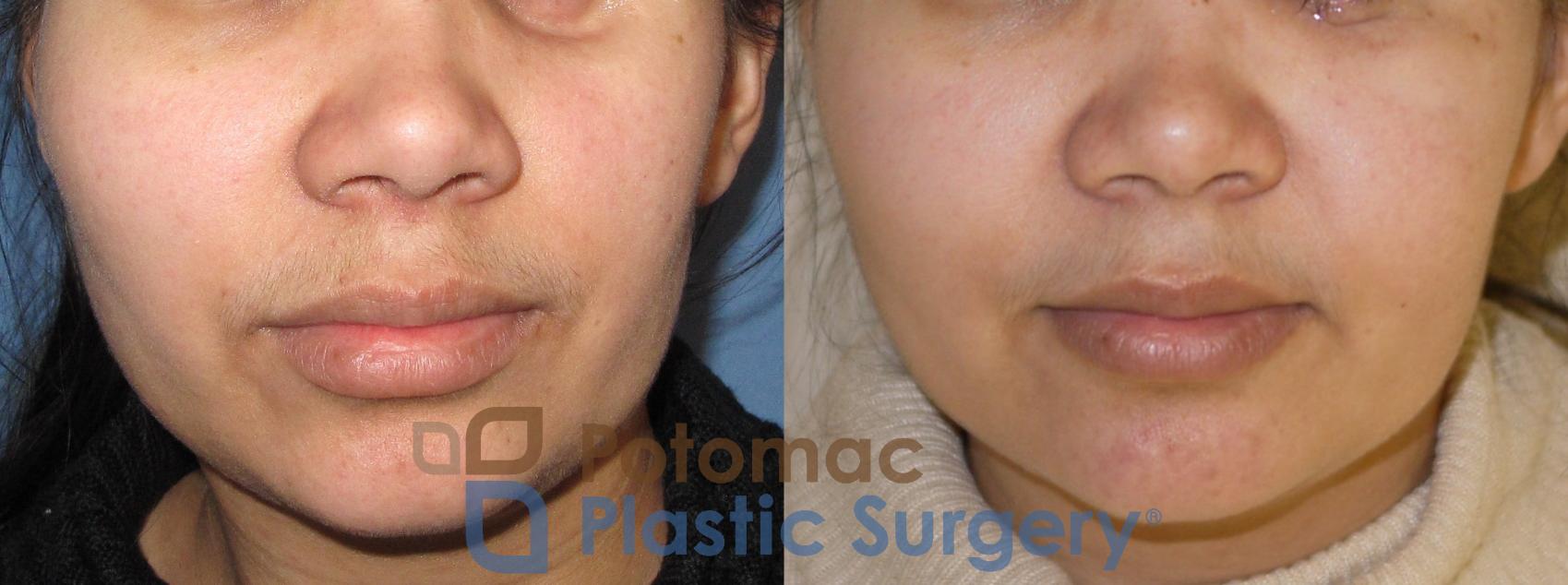 Before & After Cheek Augmentation Case 41 Front View in Washington, DC