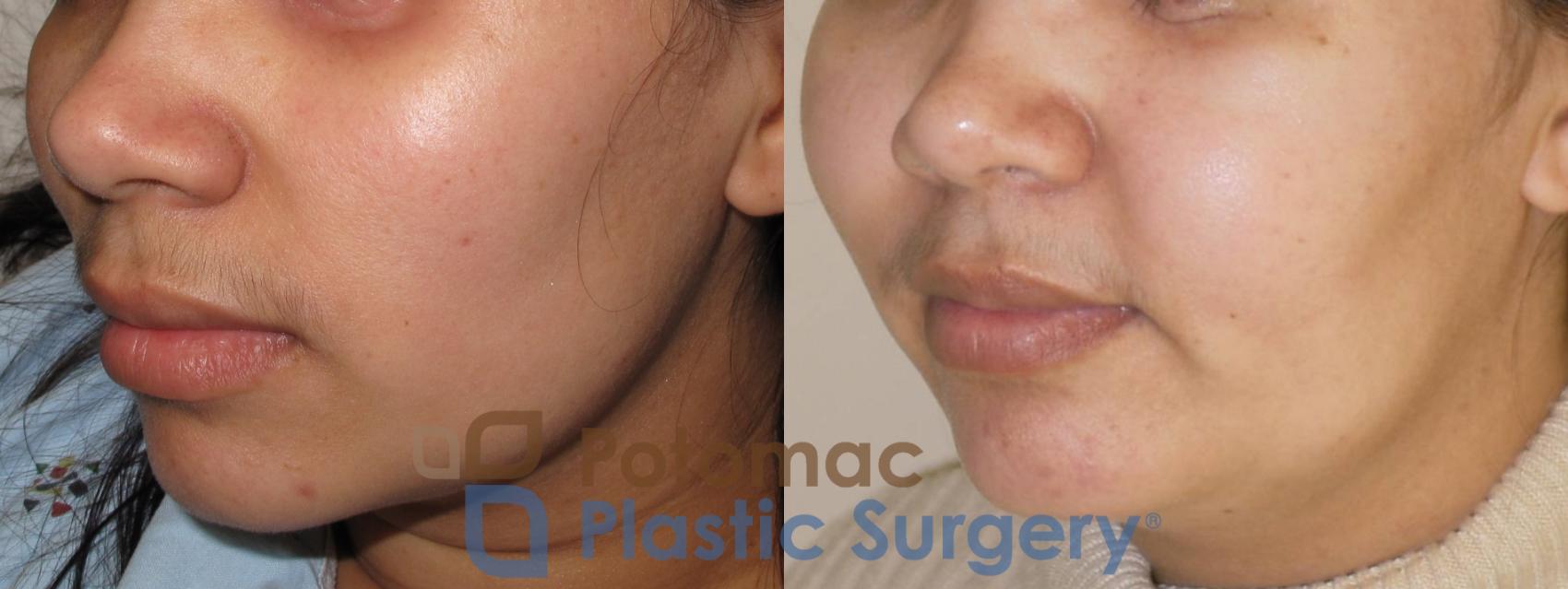 Cheek Augmentation With Silicone Implant And Fat Transfer To Balance The Face Of A Young Woman 