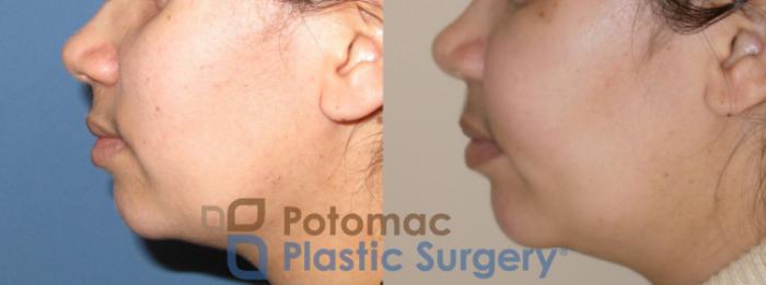Before & After Facial Sculpting Case 41 Left Side View in Washington DC & Arlington , DC