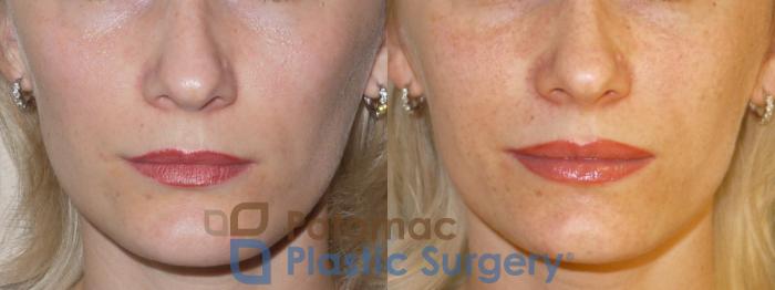 Before & After Cheek Augmentation Case 74 Front View in Washington DC & Arlington , DC
