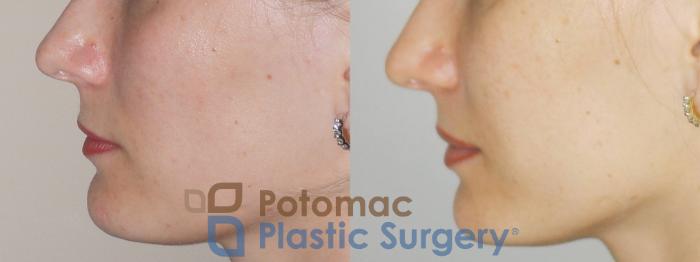 Before & After Cheek Augmentation Case 74 Left Side View in Washington DC & Arlington , DC