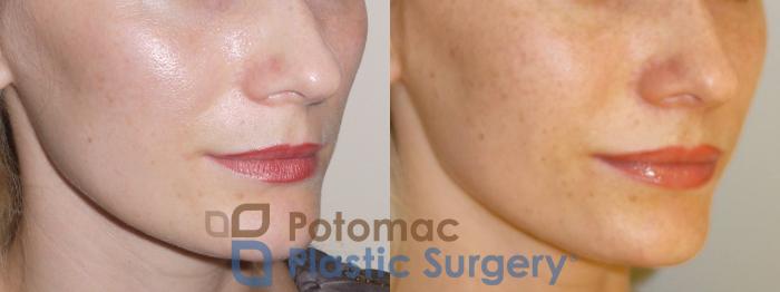 Before & After Dermal Fillers Case 74 Right Oblique View in Washington DC & Arlington , DC