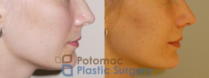 Before & After Cheek Augmentation Case 74 Right Side View in Washington DC & Arlington , DC