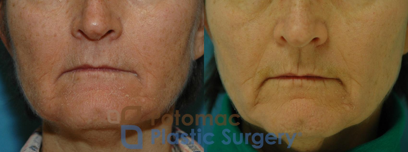 Before & After Chemical Peel Case 10 Front View in Washington DC & Arlington , DC