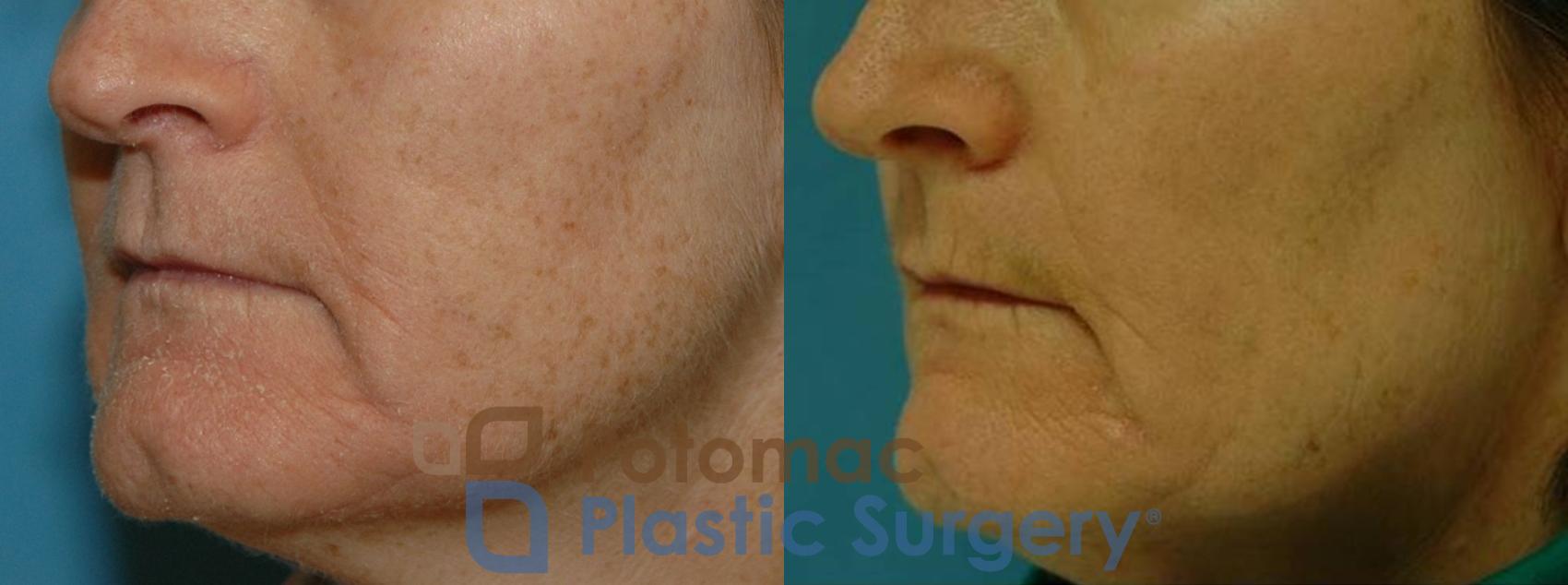 Before & After Chemical Peel Case 10 Left Oblique View in Washington, DC