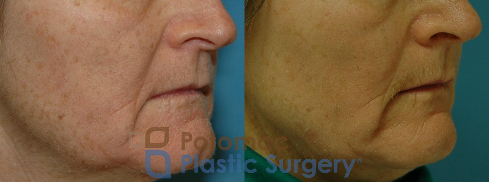 Before & After Skin Care Case 10 Right Oblique View in Washington DC & Arlington , DC